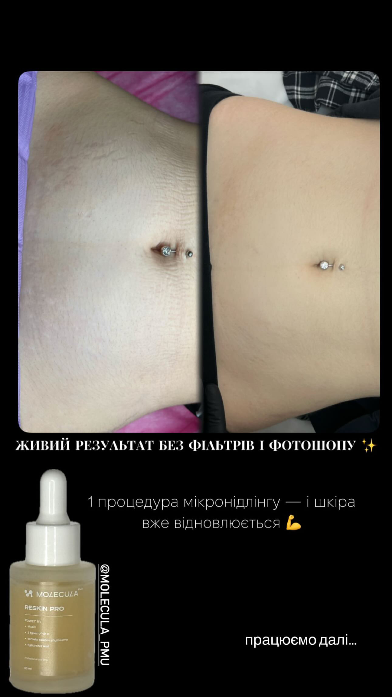 sivorotki-dlya-mikronidlingu